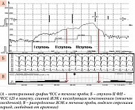 Рис. 2. Фрагмент ТТ пациентки Т. 54 лет