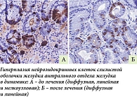 Рис. 3. Иммуногистохимическое исследование с антителами к хромогранину А (увеличение × 400).