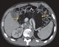 Рис. 1. Пациент С., 28 лет. Компьютерная томография органов брюшной полости: поджелудочная железа увеличена, состоит из жировой ткани, участки мягкотканой плотности, соответствующие ткани железы, не определяются
