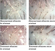 Рис. 2. Результаты трихоскопии пациентки