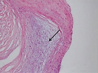 Рис. 3. Интраоперационно иссеченные образцы митрального клапана. Участки мукоидного отека в клапане на фоне склероза и гиалиноза. Окраска гематоксилин – эозин, увеличение × 100