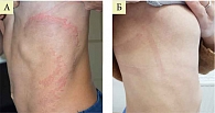 Рис. 10.  Пациентка О. с кандидозом кожи, обусловленным Candida parapsilosis, до (А) и после использования крема Офломикол (Б)