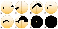 Рис. 18. Типичные дефекты поля зрения при глаукоме: А – назальная ступенька, Б – височный клин,  В – верхний дугообразный дефект, Г – ранний верхний парацентральный дефект в 10° от точки фиксации, Д – верхний парацентральный дефект, угрожающий точке фикса