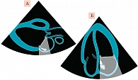 Рис. 2. Схематичное изображение аттенуации (серый цвет) и механизма маскирования потока регургитации протезом митрального клапана:  А – парастернальная позиция, Б – апикальная позиция