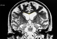 Рис. 2. МРТ головного мозга пациента с БА. Коронарный срез. Признаки диффузных атрофических изменений. Расширение угла мозолистого тела: тупой угол (128°)