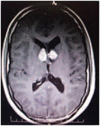 Рис. 1. МРТ головного мозга (до включения в исследование)