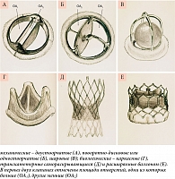 Рис. 1. Протезы клапанов сердца (масштаб не соблюден):