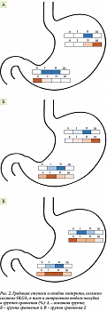 Рис. 2. Градация степени и стадии гастрита, согласно системе OLGA, в теле и антральном отделе желудка в группах сравнения (%): А – основная группа;  Б – группа сравнения 1; В – группа сравнения 2