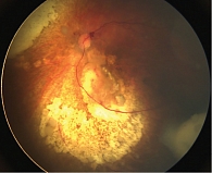 Рис. 5. Отек диска зрительного нерва и папиллярное кровоизлияние после комбинированного лечения ретинобластомы с включением ИВХТ
