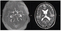 Рис. 2. Магнитно-резонансная ангиография и магнитно-резонансная томография головного мозга в режиме Т2 (магнитно-резонансный томограф с напряженностью магнитного поля 3Т)
