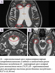 Рис. 1. МРТ головного мозга пациента с иНТГ