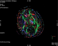 Рис. 1. Структурная цветовая карта фракционной анизотропии. Выделены участки со стороны заднего бедра внутренней капсулы, являющиеся опорными для построения кортикоспинальных трактов
