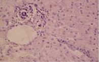 Рис. 13. Выраженная пролиферация дуктул на фоне стеатоза печени