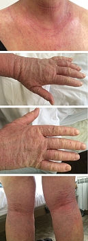 Рис. 4. Состояние кожи пациентки С. с обострением АтД до лечения
