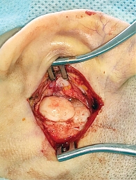 Рис. 3. Этап операции: обнажена костная стенка черепа, лоскут кожи и надкостницы фиксирован, визуализирована остеома