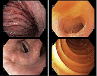 Рис. 3. ЭГДС на аппарате Olympus EVIS EXERA III (CV-190), осмотр и заключение Л.И. Телятниковой: недостаточность кардии, Hill-3; эрозивный рефлюкс-эзофагит, степень В по Hoshihara; дуоденогастральный рефлюкс; рефлюкс-гастрит с тотальным поражением желудка