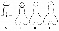 Рисунок 1. Доступы для имплантации фаллопротезов: А – инфрапубикальный,  Б – субкоронный, В – продольный пеноскротальный, Г – поперечный пеноскротальный