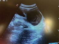 Рис. 1. УЗИ ОМТ пациентки А., 11 лет: объемное образование левых придатков матки, старый перекрут левых придатков матки