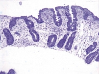 Рис. 6. Полная атрофия и субатрофия ворсинок в одном гистологическом препарате (окраска толуидиновым синим). Аутоиммунная атрофическая энт