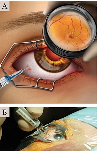 Рис. 2. Схема (А) и техника ИВХТ (Б) при ретинобластоме