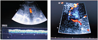 Рис. 3. Гепатофугальное направление кровотока (основной ствол воротной вены, слева), внутрипеченочные анастомозы (справа, указаны стрелками