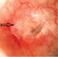Рис. 1. Прорезывание дренажа «Репегель А-1» через конъюнктиву после удаления швов с конъюнктивы