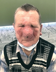 Рис. 1. Общий вид лица пациента: нос увеличен в два раза, кожа щек и лба в области переносицы утолщена и гиперемирована