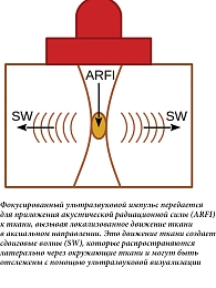 Рис. 1. Основной принцип сдвиговой эластографии