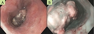Рис. 1. Эндофото первичной меланомы пищевода  (А – осмотр в белом свете; Б – осмотр в режиме NBI)