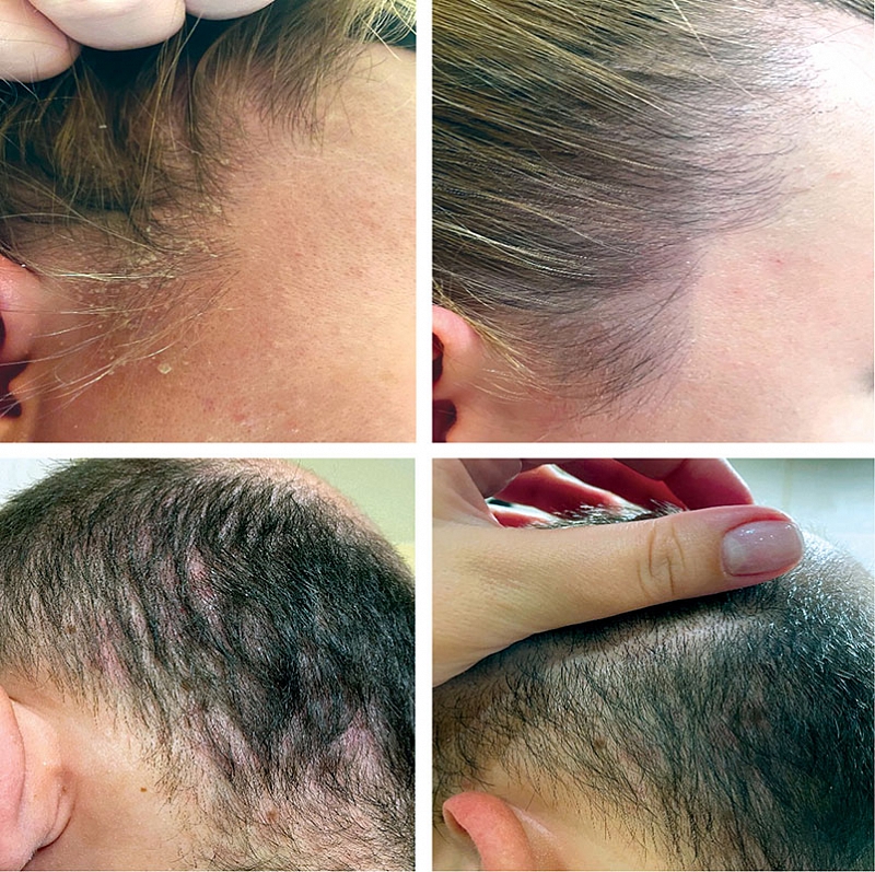 Себорейный дерматит волосистой части головы: от патогенеза к .