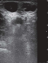 Рис. 15. УЗ-картина кист левой молочной железы у 15-летней девочки