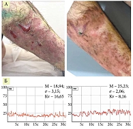 Рис. 5. Пациент М.: А – до и после проведения комплексной терапии с применением 12 процедур НАП; Б – лазерная допплеровская флоуметрия микроциркуляции того же пациента до и после 12 процедур НАП