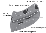 Рис. 4. Схематичное изображение анатомо-функциональных изменений структуры шейки матки как УЗ-признаков хронического эндоцервицита [15]