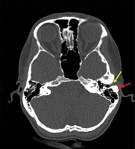 Рис. 2. Данные компьютерной томографии височных костей пациентки Ш.: сосцевидные отростки пневматического типа строения, барабанная полость и антрум свободны, красная стрелка указывает на новообразование сосцевидного отростка