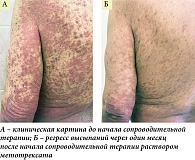 Рис. 7. Динамика патологического процесса у пациента группы 1А: