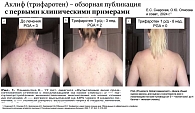 Рис. 2. Регресс воспалительных элементов у пациентки К. после лечения препаратом Аклиф (вырезка из опубликованной статьи)