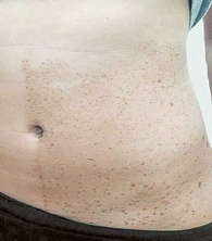 Рис. 2. Асимметричное расположение пятен цвета «кофе с молоком» (фото из личного архива Д.Г. Джаваевой)