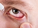 Разнообразие форм и проявлений синдрома «сухого глаза» –  единый подход к терапии. X Российский общенациональный  офтальмологический форум. Сателлитный симпозиум компании «Новартис Фарма»