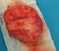 Рис. 2. Макропрепарат гигантской ювенильной фиброаденомы молочной железы у 13-летней девочки