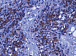 Дендритно-клеточная иммунотерапия в сочетании с фотодинамической терапией и циклофосфамидом у больных диссеминированной меланомой кожи, резистентных к стандартным методам лечения