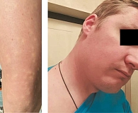 Рис. 1. Аллергическая реакция в виде крапивницы и эритемы на анестетик (тетракаин), использованный перед лазерной эпиляцией