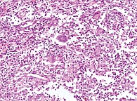 Рис. 4. Болезнь Крона в форме терминального илеита: эпителиоидноклеточная гранулема с гигантскими многоядерными клетками в толще кишечной стенки. Окраска гематоксилином и эозином. Увеличение ×300