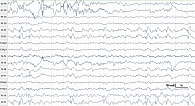 Рис. 2. ЭЭГ пациентки в 9,5 года: базовая активность дезорганизована, преобладают тета-волны. В центральных отделах частые разряды комплексов «спайк – волна», максимально выраженные в отведениях C3, Cz, C4
