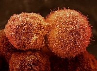 Клетки рака поджелудочной железы человека (фото Visuals Unlimited / Corbis)