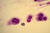 Рис. 4. Материал браш-биопсии. Цитологический препарат опухолевых клеток с центрально расположенными ядрами, эозинофильной цитоплазмой и признаками секреции (окраска по Романовскому – Гимзе, 40-кратное увеличение)
