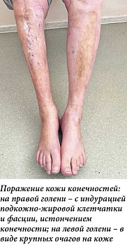 Рис. 2. Пансклеротическая склеродермия.