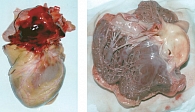 Рисунок 4. ДСТ – разрыв аневризмы дуги аорты(слева);  множественные ложные хорды левых и правых отделов сердца(справа)