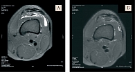 Рис. 4. Площадь синовита левого коленного сустава у пациентки Д. по данным МРТ исходно (А – 8,1 см2) и через шесть месяцев приема Артнео (Б – 1,5 см2)