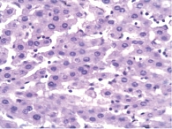 Рис. 6. Восстановление балочной структуры печени: еще сохранены гепатоциты в состоянии дистрофии, но во многих гепатоцитах ядра гиперхромные и много двуядерных гепатоцитов. Окраска гематоксилином и эозином, × 400