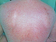 Рис. 6. Пациент М., 56 лет, диагноз «псориатическая эритродермия после раздражающей местной терапии», эритема свыше 95% кожного покрова